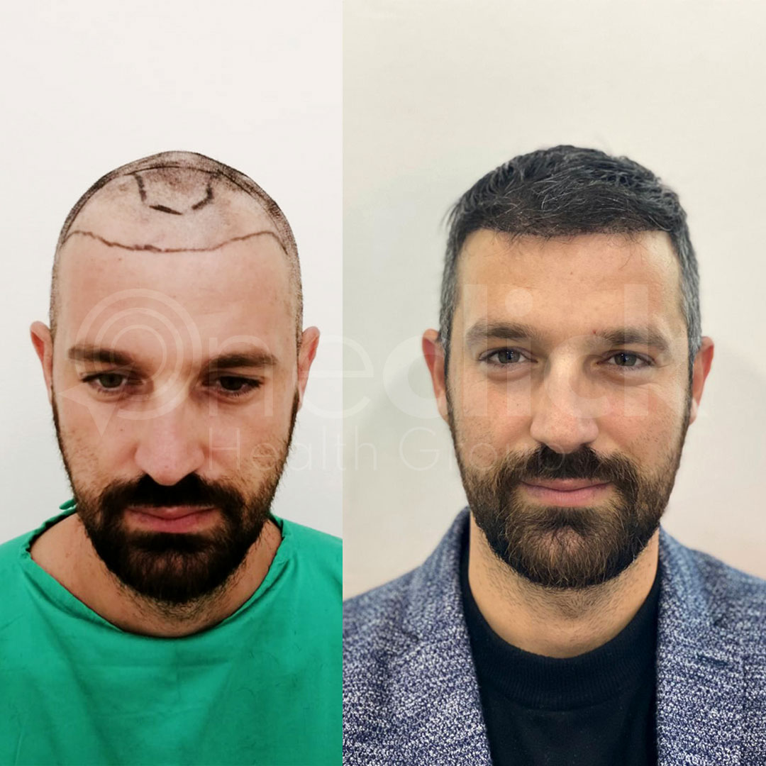 Hair Transplant