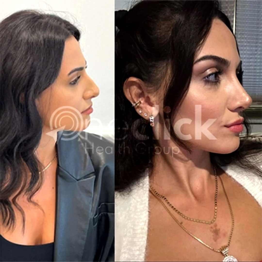 Rhinoplasty