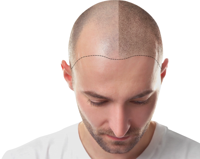 DHI Hair Transplant
