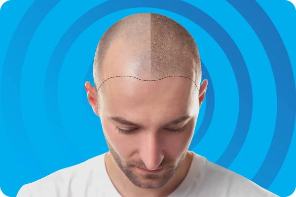 DHI Hair Transplant