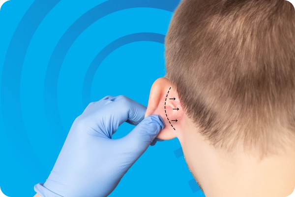 Otoplasty Surgery